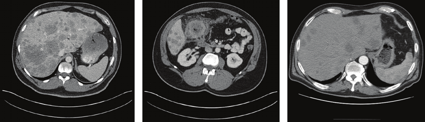 a-CT-scan-of-the-abdomen-showing-innumerable-liver-metastases-in-a-patient-Case-1.png